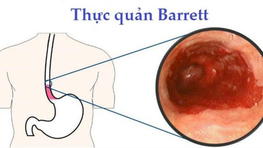 Hiện tượng tế bào niêm mạc ở thực quản bị chuyển đổi thành tế bào giống như tế bào ở ruột gọi là hiện tượng barrett thực quản